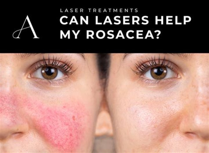 Can apple cider vinegar help with rosacea