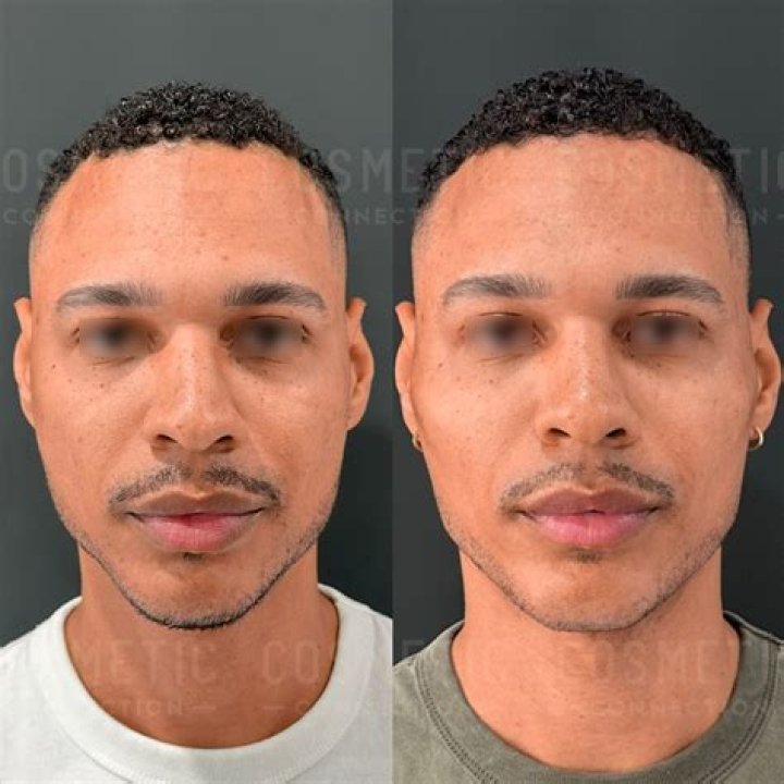 Has Adam Driver Done Plastic Surgery? His Botox And Jawline Surgery Rumors Explained!