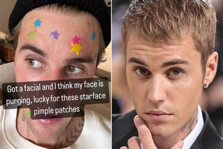 
Justin Bieber Shares Post-Facial Selfie Covered in Pimple Patches: ‘I Think My Face Is Purging’ 