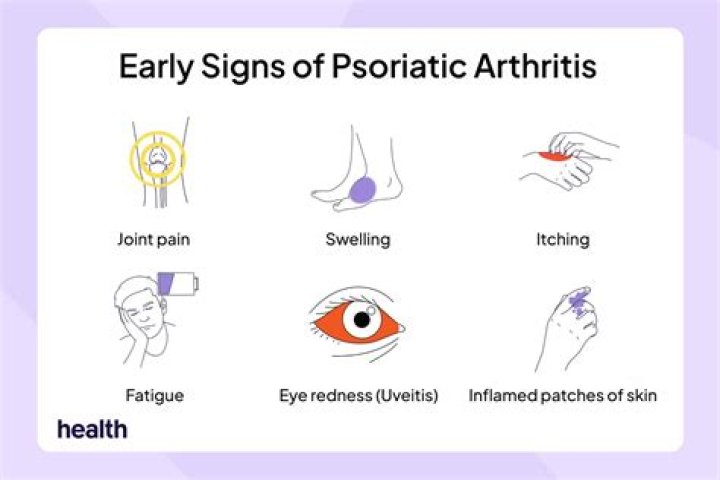 
Lance Bass Illness And Health Issues Explained- What Is Psoriatic Arthritis? 